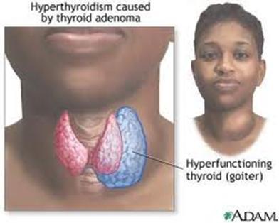 Toxic adenoma Hyperfunctioning nodule Nodule diameter > 3 cm Typically in