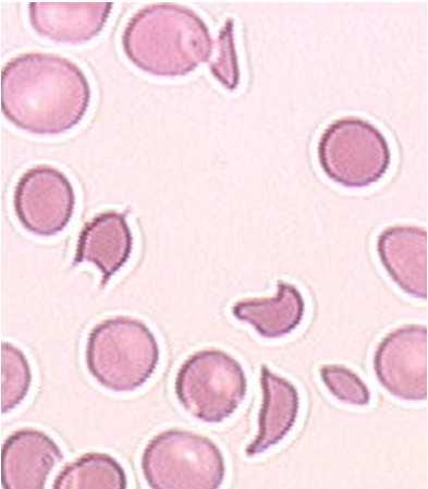 Thrombotic microangiopathies (TMAs) TMA = a syndrome There is not one TMA, but many forms of