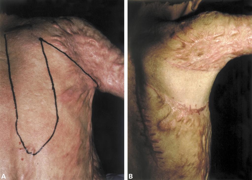 104 British Journal of Plastic Surgery due to pressure on the flap caused by incomplete postoperative fixation.