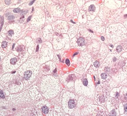 Hepatic Steatosis - Classification According to Droplet Size Macrovesicular Single large droplet, nucleus displaced to one side Microvesicular Numerous small droplets, nucleus remains central Fatty