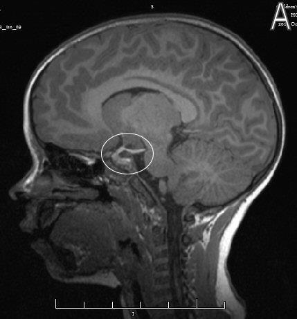 The MRI showing