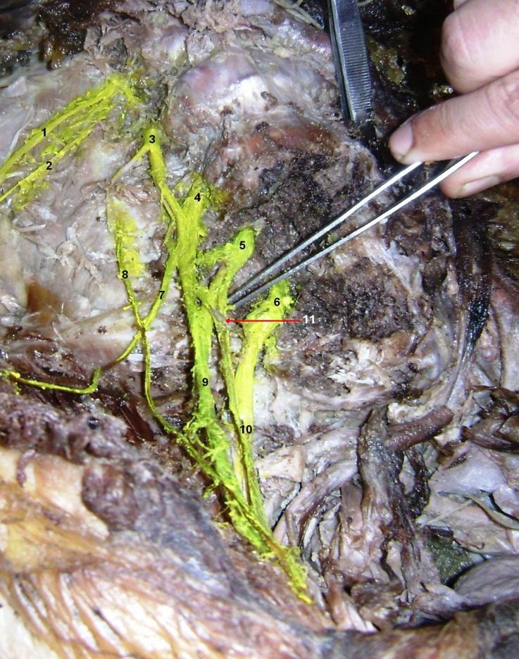 Photograph 1: Lumbar Plexus with one additional branch from the lumbosacral trunk joining the femoral nerve.