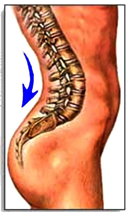 SCOLIOSIS- LATERAL CURVATURE - can be due to