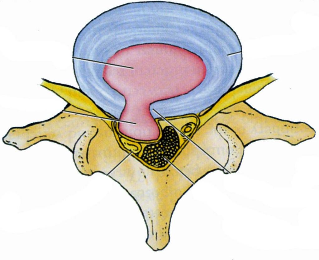 LIGAMENT Herniation typically occurs in a Postero-Lateral Direction: Post.
