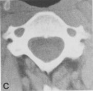 FEATURES OF CERVICAL VERTEBRA ON CT Body is small,