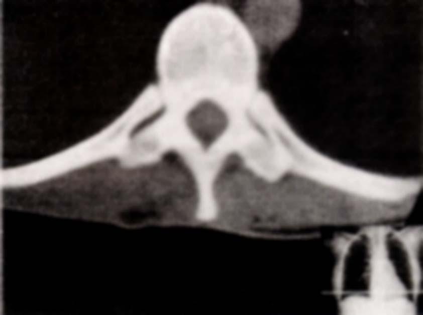 LANDMARKS, FEATURES OF THORACIC VERTEBRA ON CT BODY THORACIC AORTA facets for