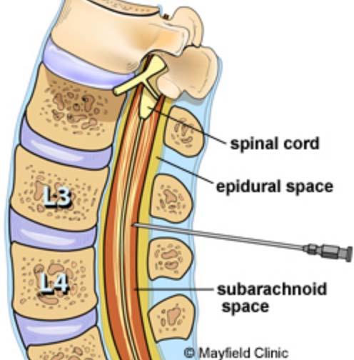 SEQUENCE OF STRUCTURES PENETRATED IN EPIDURAL ANESTHESIA, LUMBAR