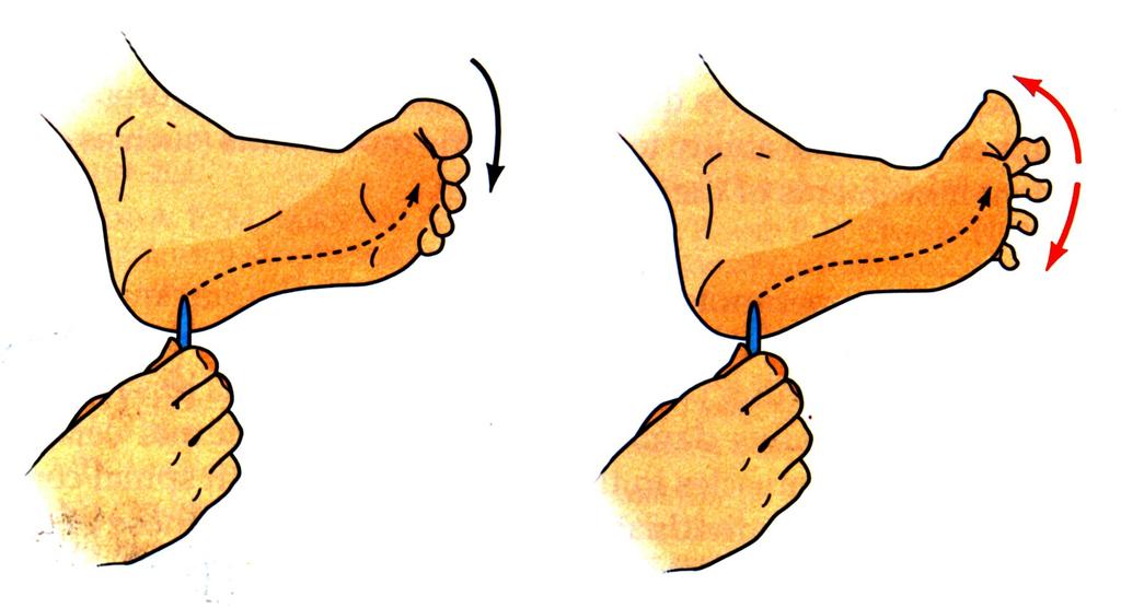 BABINSKI SIGN NORMAL RESPONSE BABINSKI SIGN (EXTENSOR PLANTAR RESPONSE) STIMULUS TO SKIN OF SOLE OF FOOT FLEX TOES (DOWN) EXTEND BIG TOE, FANNING (ABDUCTION)