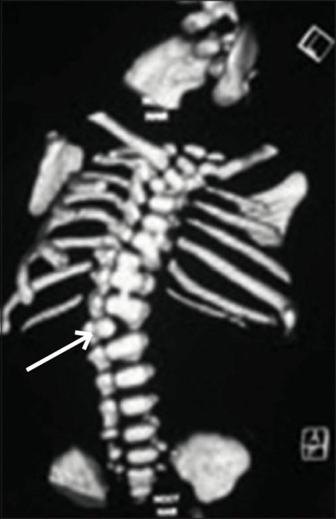 4. A 2.2 kg girl was born at 34 weeks and showed severe respiratory distress. The neonate had a malformed thorax that limited normal respiration.