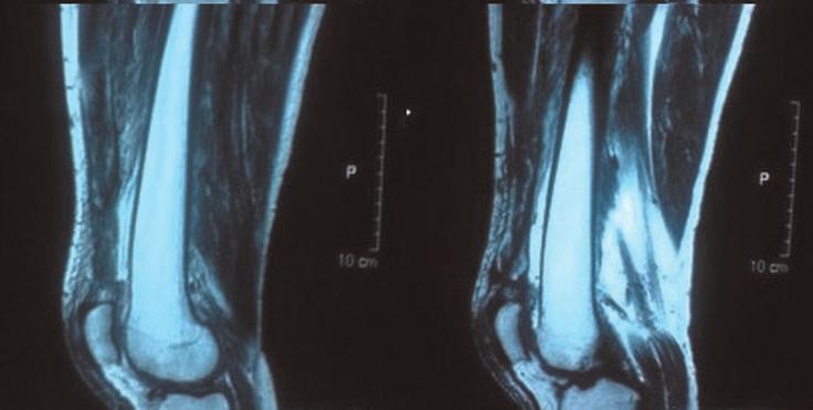 Plain radiographs revealed a phase II chronic tendinopathy of the superior pole of patella on both sides of his knee. This was attributed to his frequent squatting and kneeling on the farm.