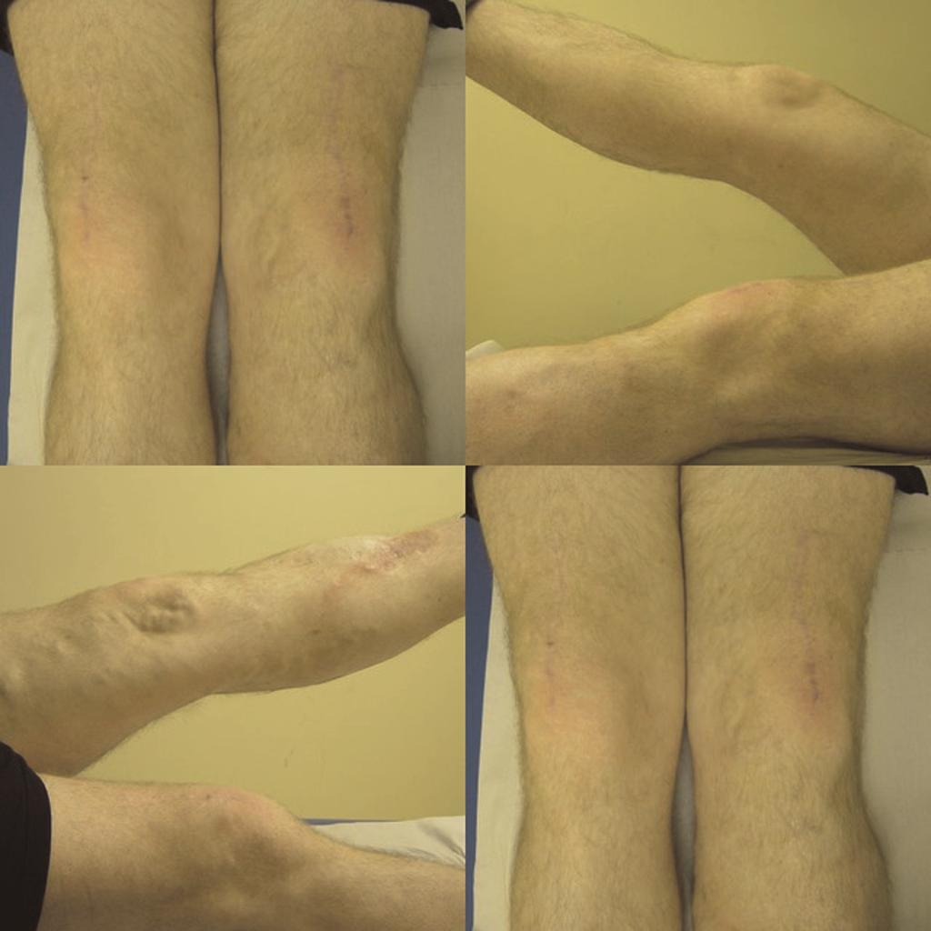 Figure 3. Follow-up pictures at three years after surgical repair. The well-healed operation sites on both knees.