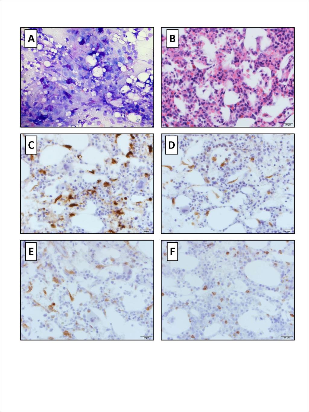 Mastocytosis associated with CML Hematopathology - March 2016 Figure 1: Bone marrow biopsy from January 2014.