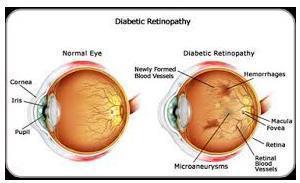 Fig3: Diabetic Retinopathy Most often, diabetic retinopathy has no symptoms until the damage to your eyes is severe.