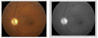 Step1: Input Fundus Images Read the input image from Fundus camera. The Fundus camera is more reliable, non-invasive and easy to use compared to traditional ophthalmoscopy.