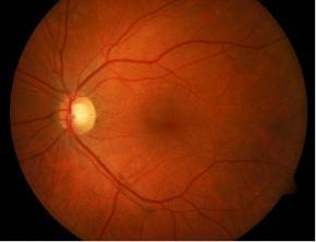2 Optic disc detection Optic disc (OD) which has a circular shape and high intensity appears as bright, yellowish color.