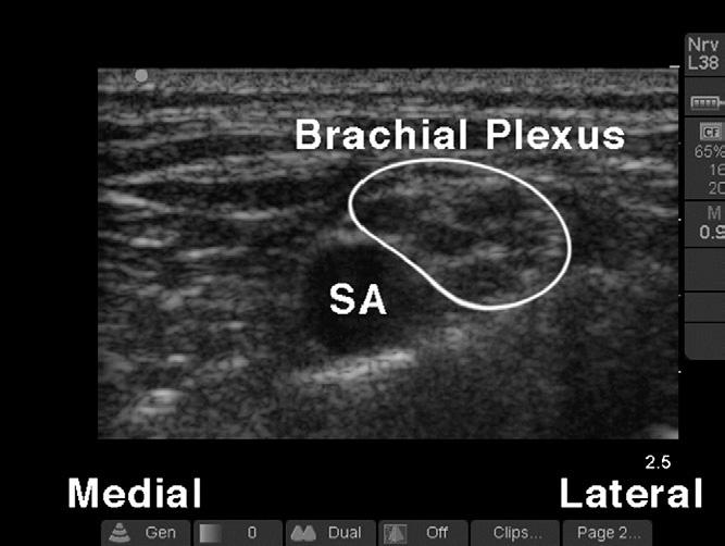 Ultrasound guided brachial plexus nerve vs procedural 707 personnel, preprocedural fasting, and observation during postprocedural recovery.