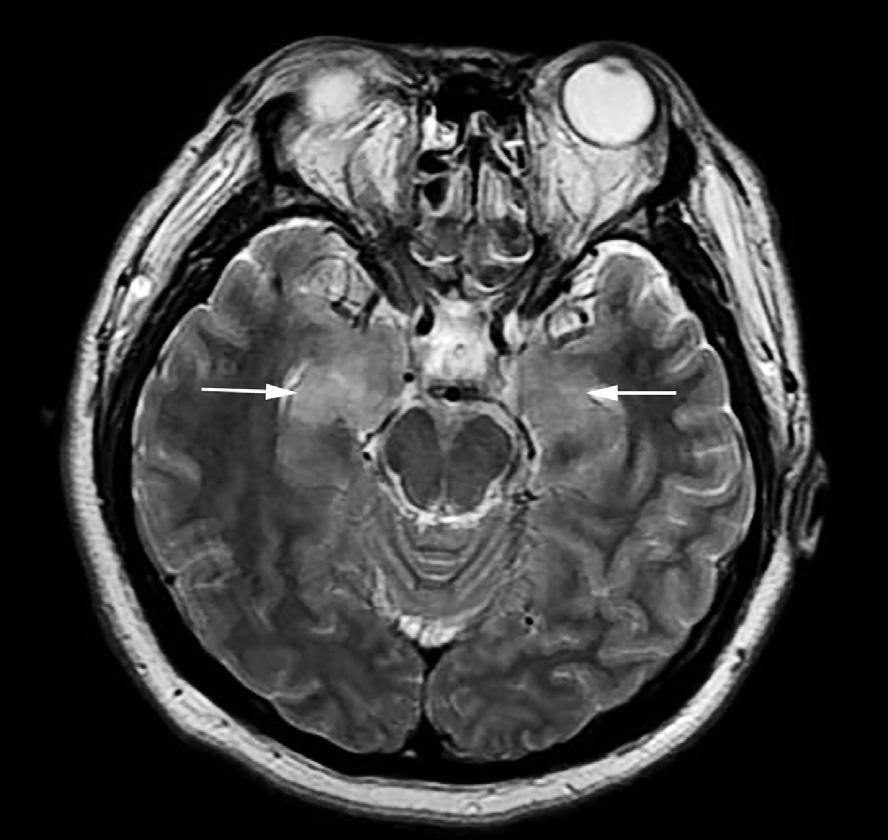 Hippocampal Involvement of Mumps Meningoencephalitis orientation and cognition with decreased attention. He responded only to painful stimulation and presented with aphasia.