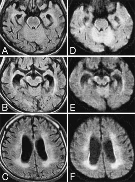 Figure3. BrainMRI89daysaftertheonsetofneurologicalsymptoms.MRIstudieswereperformedusinga1.5-TMRunit(SignaHorizonLX;GEMedicalSystems,Milwaukee,WI)equipped withaconventionalheadcoil.