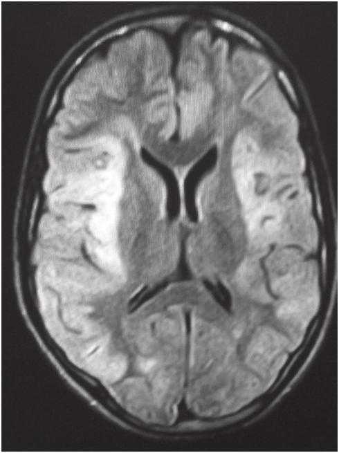 10%) all efforts to identify causative organism was futile and patients were treated and discharged clinically as encephalitis. Among 5 patients with positive JE serology, 4 (80.