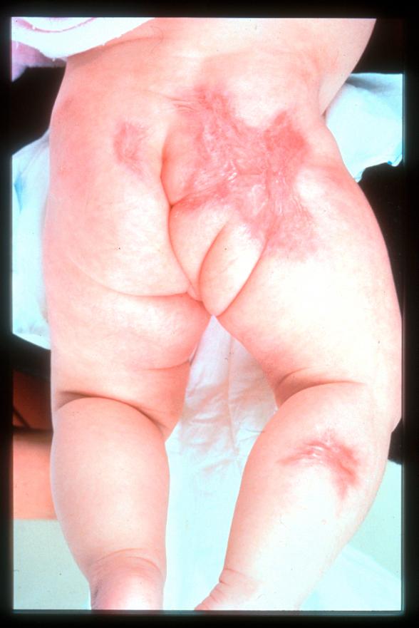 CNS sequelae of congenital Varicella Skin scars ~80% Eye defects 60% Limb abnormalities ~70% Cortical atrophy, Low IQ 46% Poor sphincter