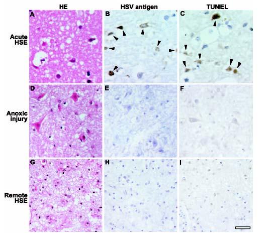 HSE Pathogenesis direct damage from virus versus role of host response Neuronal