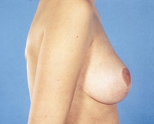 sagging of the breast tissue.
