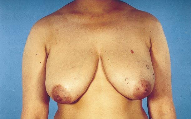 fold and upwards projection of the nipple areola complex