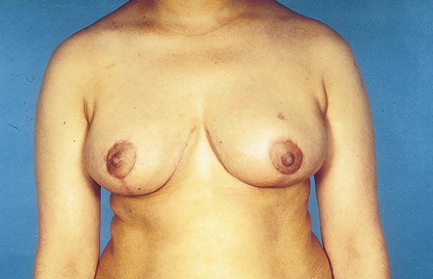 (B) Twelve months after reduction mammaplasty with the