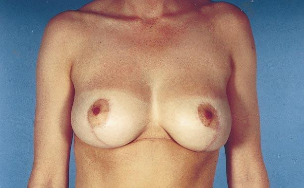 Sagging of the breast is defined as an increase in length of the vertical inframammary distance and not in a change of the sternal notch-to-nipple distance.