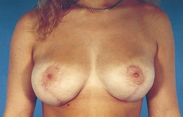 Puckering of the skin particularly in the upper part of the areola and slight secondary widening of the areola. (3.4 to 6.7%).