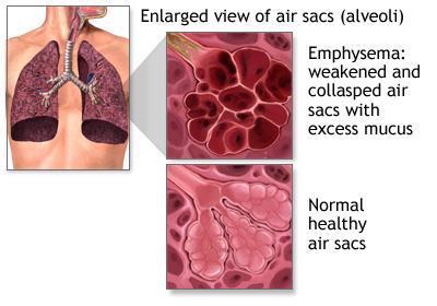 COPD - Emphysema In emphysema, the little air sacs (called alveoli) at the end of the airways