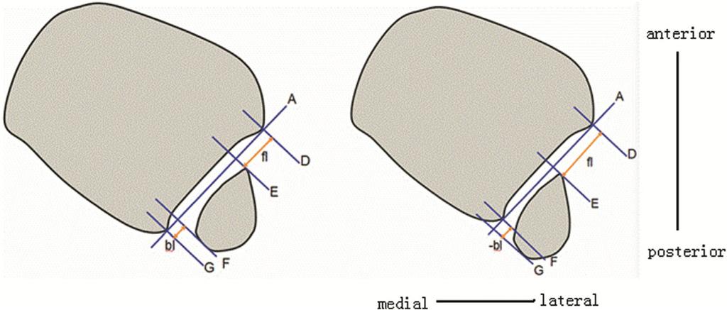 Yu et al. Journal of Orthopaedic Surgery and Research (2018) 13:95 Page 4 of 7 Fig. 4 Calculation of the posterior and extra-posterior indices in the relatively posterior fibula.