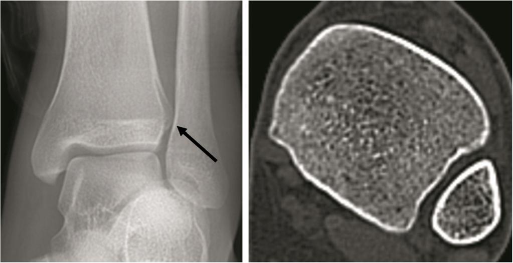 Yu et al. Journal of Orthopaedic Surgery and Research (2018) 13:95 Page 5 of 7 Fig. 5 X-ray and CT scans of the DTS with a separated left ankle joint and b normal left ankle joint.