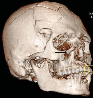 Right arrow indicates D2 deviation fracture line associated with high level LeFort I. done on demographics of facial fractures.