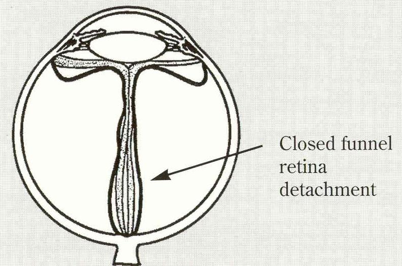 Severe Stage 5 Retinopathy of Prematurity Stage 5: Total Retinal Detachment is a complete, funnelshaped retinal detachment with poor visual prognosis.