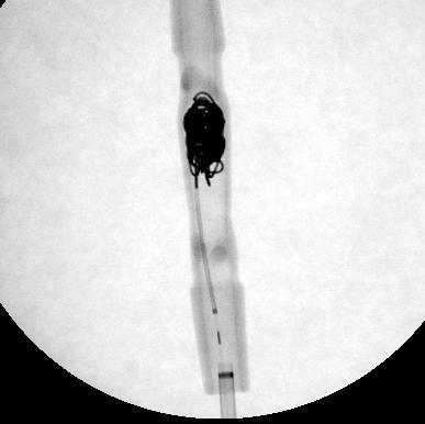 LANTERN high-flow microcatheter Coil still within tip of catheter POD Packing Coil