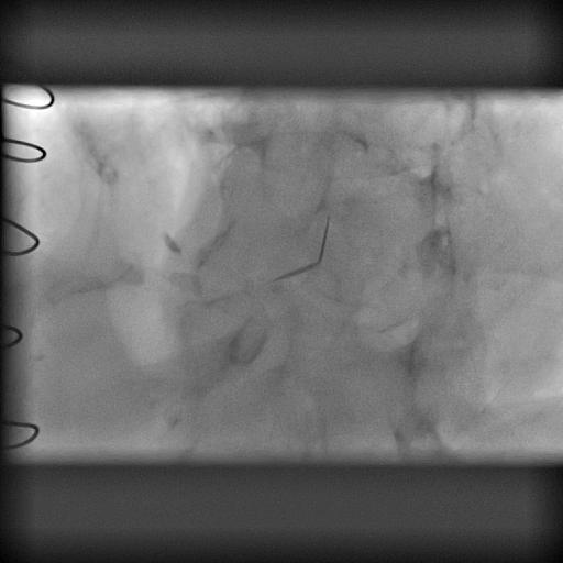 An approach to prosthetic AV stenosis What is your diagnosis?