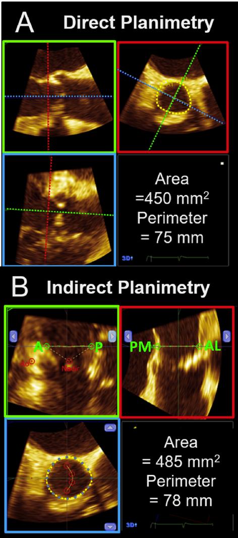 Measuring The Aortic Annulus with 3D mmhg 60 50 40 30 20 10 0 35.7 0.9 Echocardiographic Outcomes Mean Gradient and Aortic Valve Area Mean Gradient p < 0.0001 p < 0.