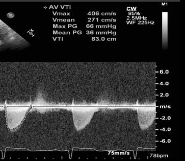 Aortic Valve Function Normal Suggests Stenosis Peak Velocity < 3 m/s > 4 m/s Mean