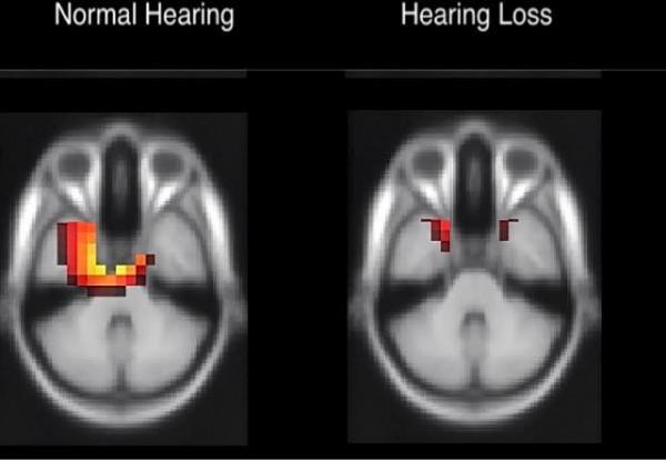 Neural Reorganization Acoustical Society of America (ASA). How does the brain respond to hearing loss? ScienceDaily. ScienceDaily, 19 May 2015.