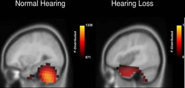 Neural Reorganization Adults with mild age-related hearing loss (right) show brain reorganization in hearing portions of brain,