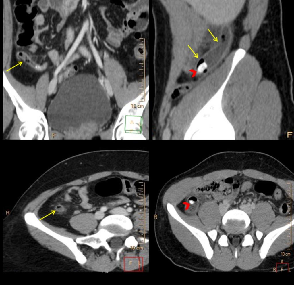 Fig. 6: MDCT images with intravenous contrast medium in two different patients with acute appendicitis.