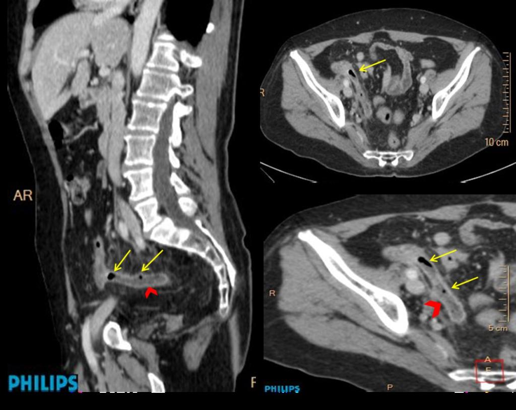 Fig. 2: Appendicitis in a 63-year-old woman.