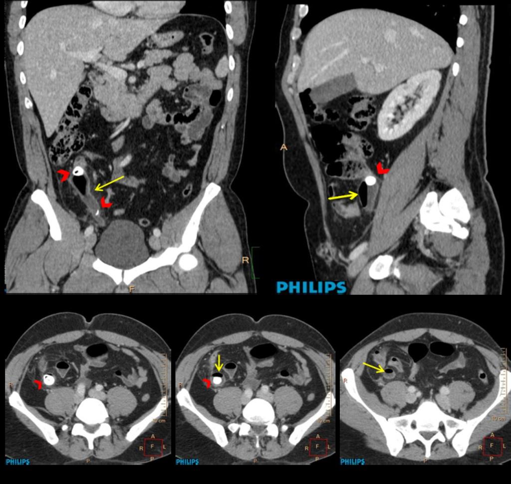 Fig. 3: Coronal (a), sagital (b) and consecutive axial (c-e) MDCT images with intravenous contrast medium in 40 year-old man with non-perforated appendicitis (histopathological report) showing a