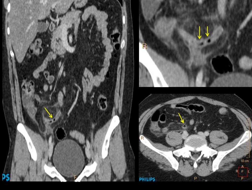 Fig. 4: MDCT with intravenous contrast medium in a 33 year-old man with acute gangrenous appendicitis (histopathological outcome).