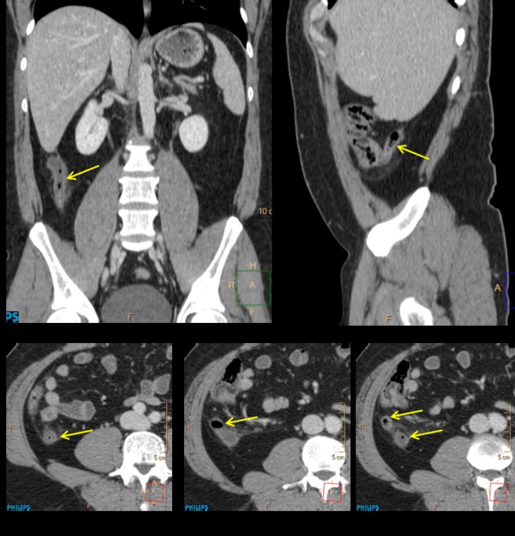 Fig. 5: Appendicitis in a 39 years-old man. MDCT with intravenous contrast medium.