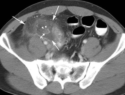 xial CT image shows mildly enhanced appendix (arrows) with diameter of 6 mm and minimal