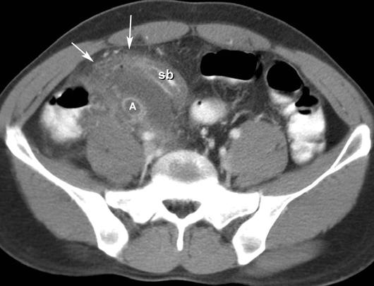 27-year-old man with perforated acute appendicitis.
