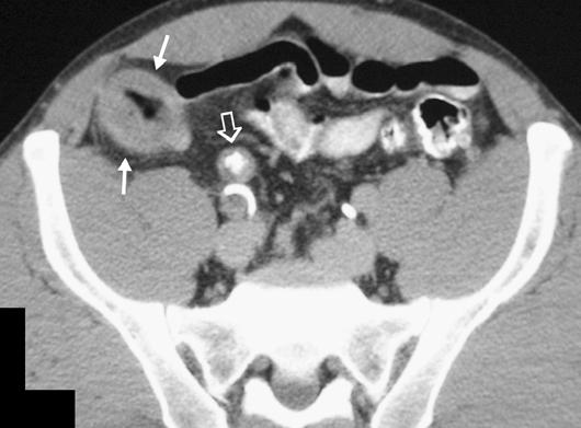 Helical CT of cute RLQ Pain Fig. 4. 43-year-old man with Crohn s disease. xial CT scan shows circumferential wall thickening of cecum (solid arrows) and terminal ileum (open arrow).