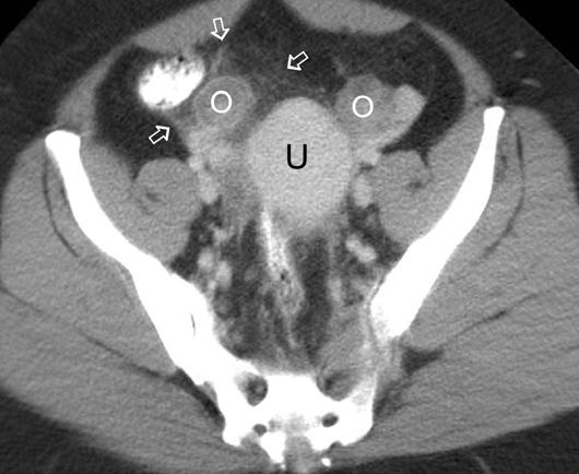 Yu et al. Fig. 6. 34-year-old woman with acute right lower quadrant pain.